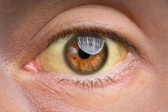 Although liver cancer is often silent in the beginning stages, Adair highlights that once it becomes more advanced, patients may start to develop symptoms such as jaundice, unexplained weight loss, tiredness and/or nausea.
