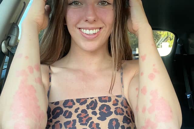 Bree Pease: “I no longer let it stop me” 