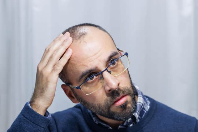 Alopecia is a general term for hair loss, and it can affect hair on all areas of the body – including on the face. Some people experience patches of hair loss in the beard area (alopecia barbae), while others may lose eyelashes or localised hair loss affecting the eyebrows.