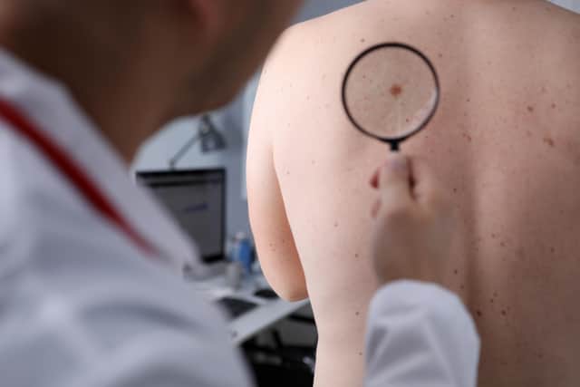Skin cancer cases reach record high – how to spot the signs