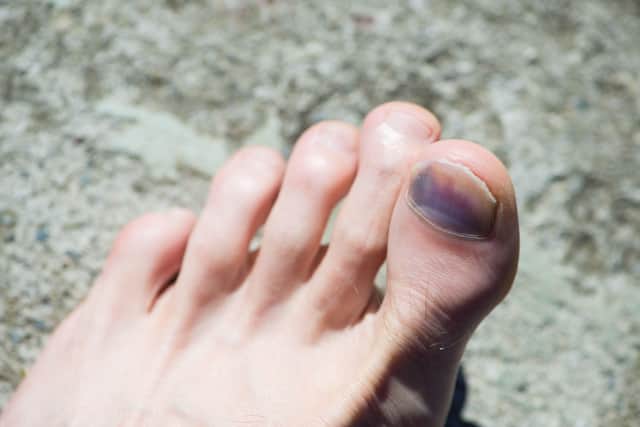 Common foot problems faced by runners – and how to solve them