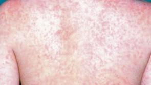 ALERT: Symptoms of measles to watch out for amid increase in cases