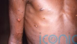 REVEALED: Total number of cases of monkeypox confirmed so far in Ireland