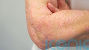 Psoriasis Awareness Month: Everything you need to know