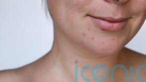 How can you get rid of acne scars? From serums to laser treatments, experts talk through the options