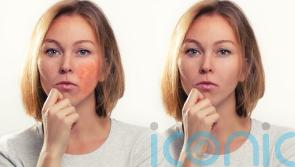 Could your flushed skin be rosacea? Experts highlight the early signs and symptoms