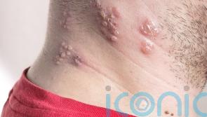 Shingles vaccine ‘cuts dementia risk by 17%’ – what is shingles and how does the vaccine work?