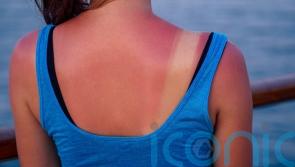 How to soothe painful sunburn