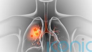 Lung Cancer Awareness Month: Can I get lung cancer if I’ve never smoked?  