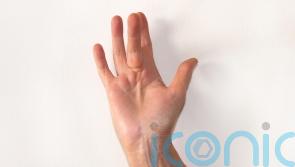 What is Dupuytren’s contracture and how serious is it?