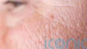 Melanoma awareness month: Is it an age spot or skin cancer?