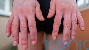 Why do my hands and feet swell in the summer?