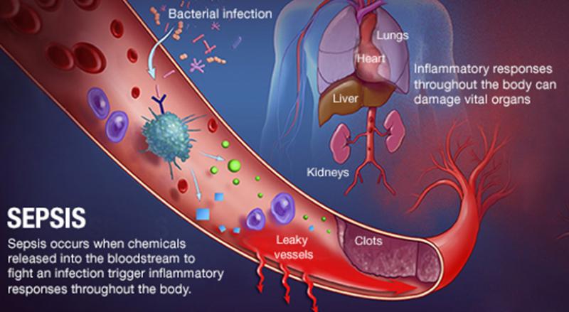 Have you asked? Could it be Sepsis?