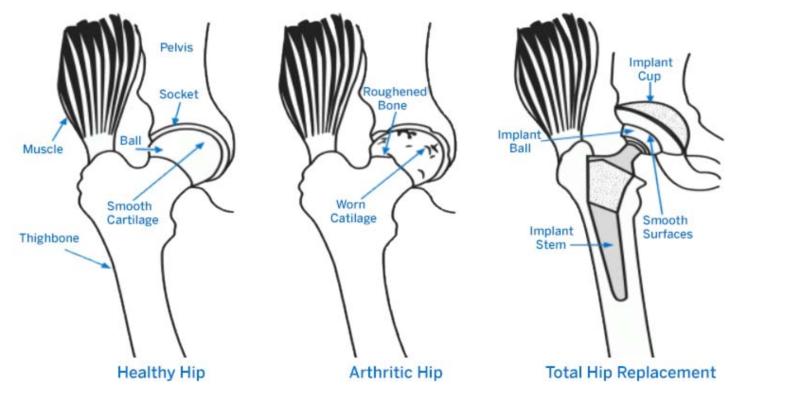 New hip, new limp: Total hip replacement