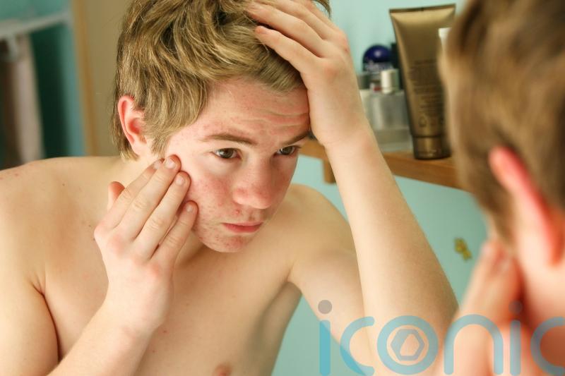 How to support a teenager who has acne