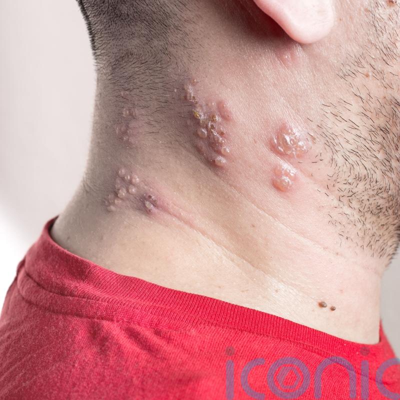 Shingles vaccine ‘cuts dementia risk by 17%’ – what is shingles and how does the vaccine work?