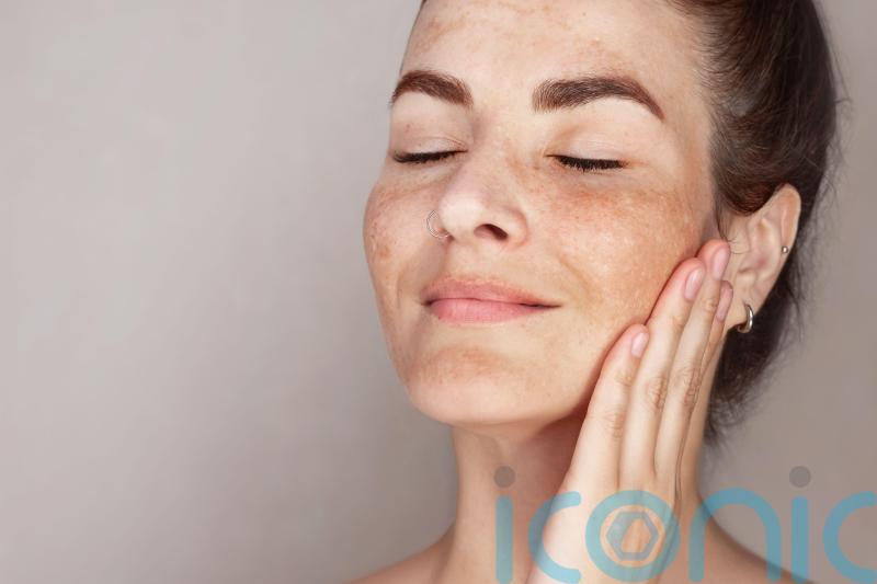 Why does the sun give me hyperpigmentation and what can I do about it?