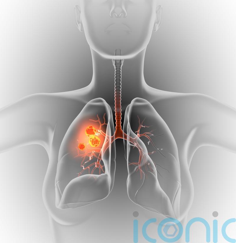 Lung Cancer Awareness Month: Can I get lung cancer if I’ve never smoked?  