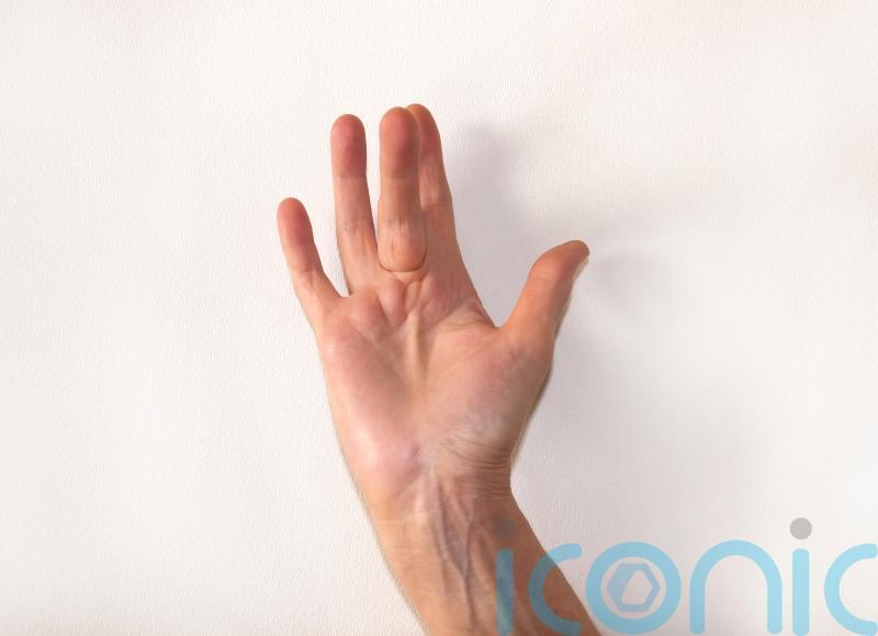 What is Dupuytren’s contracture and how serious is it?