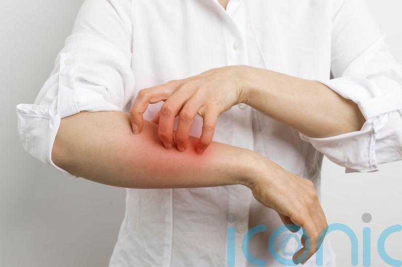 How to spot, treat and prevent scabies