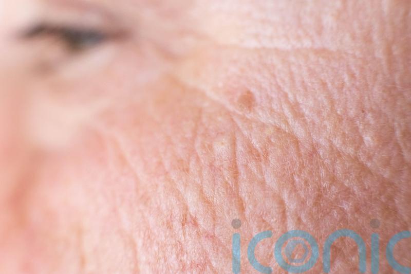 Melanoma awareness month: Is it an age spot or skin cancer?